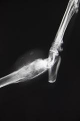 Radiographie tumeur osseuse rambouillet